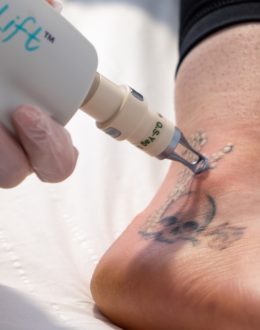 How Painful Is Tattoo Removal?