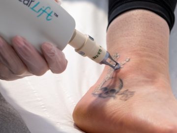 How Painful Is Tattoo Removal?