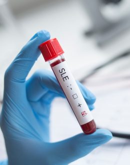 Scientists say they have identified a root cause of lupus