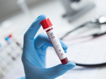 Scientists say they have identified a root cause of lupus