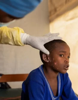 WHO declares mpox outbreaks in Africa a global health emergency