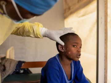 WHO declares mpox outbreaks in Africa a global health emergency