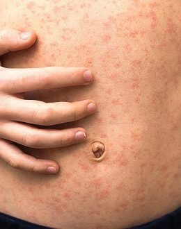 Measles Outbreak in Texas Raises Concerns for California: Signs, Prevention, and Preparedness