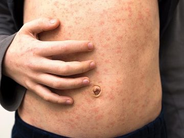 Measles Outbreak in Texas Raises Concerns for California: Signs, Prevention, and Preparedness