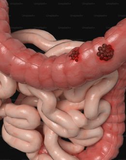 The One Food That Could Save You from Colon Cancer