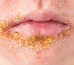 Flesh-Eating Bacteria Surge in California: What You Need to Know