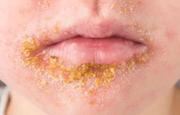 Flesh-Eating Bacteria Surge in California: What You Need to Know