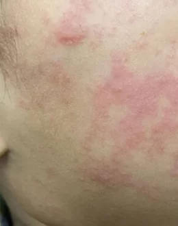 More measles cases so far in 2025 than in all of last year in California