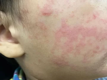 More measles cases so far in 2025 than in all of last year in California