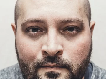 How to Get Rid of Dark Circles and Eye Bags