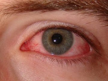 Why Winter Is Drying Out Your Eyes — and How to Find Real Relief