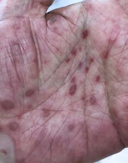 Syphilis Is Surging in California—and a Critical Drug Shortage Is Putting Latino Families at Risk