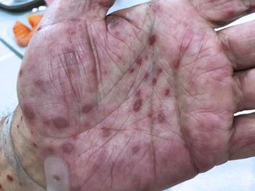 Syphilis Is Surging in California—and a Critical Drug Shortage Is Putting Latino Families at Risk