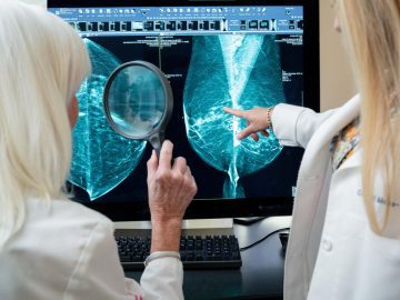Sharp 29% Rise in Breast Cancer Among Young Women Over Three Decades