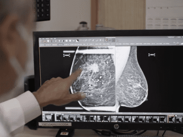 New Breast Cancer Drugs Are Changing Treatment. Here’s When They May Work Better Than Chemotherapy
