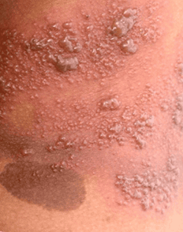 Before the Blisters: The Shingles Warning Sign Many People Miss