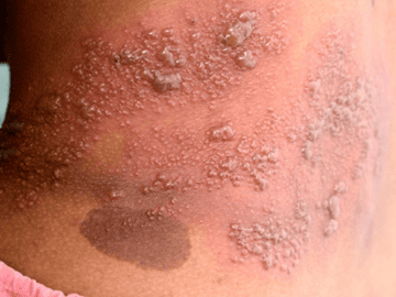 Before the Blisters: The Shingles Warning Sign Many People Miss